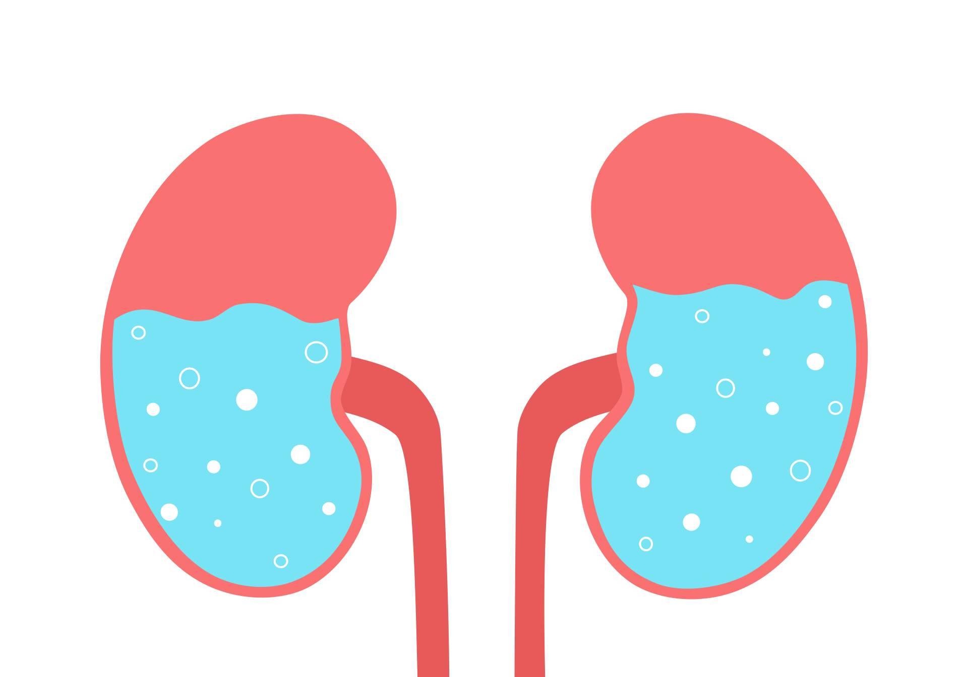 Cómo la hidronefrosis puede afectar la salud renal de los niños
