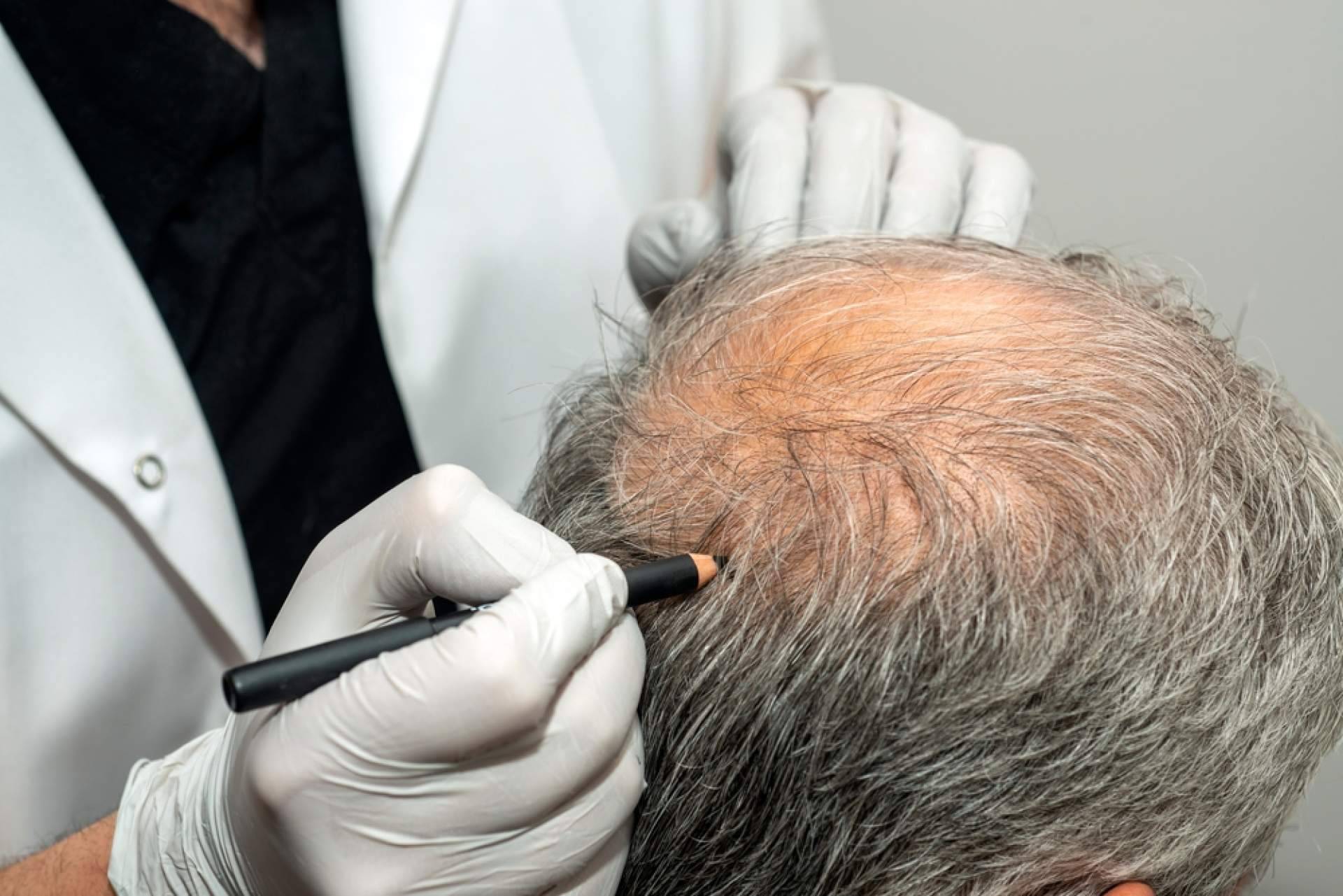 Técnica FUE Zafiro HD y mesoterapia regenerativa; la fórmula del Dr. Mora para un trasplante capilar óptimo