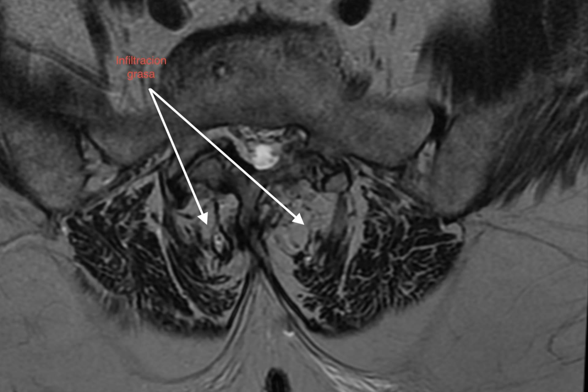 Impacto de la sarcopenia y la infiltración grasa paravertebral en la degeneración del segmento adyacente
