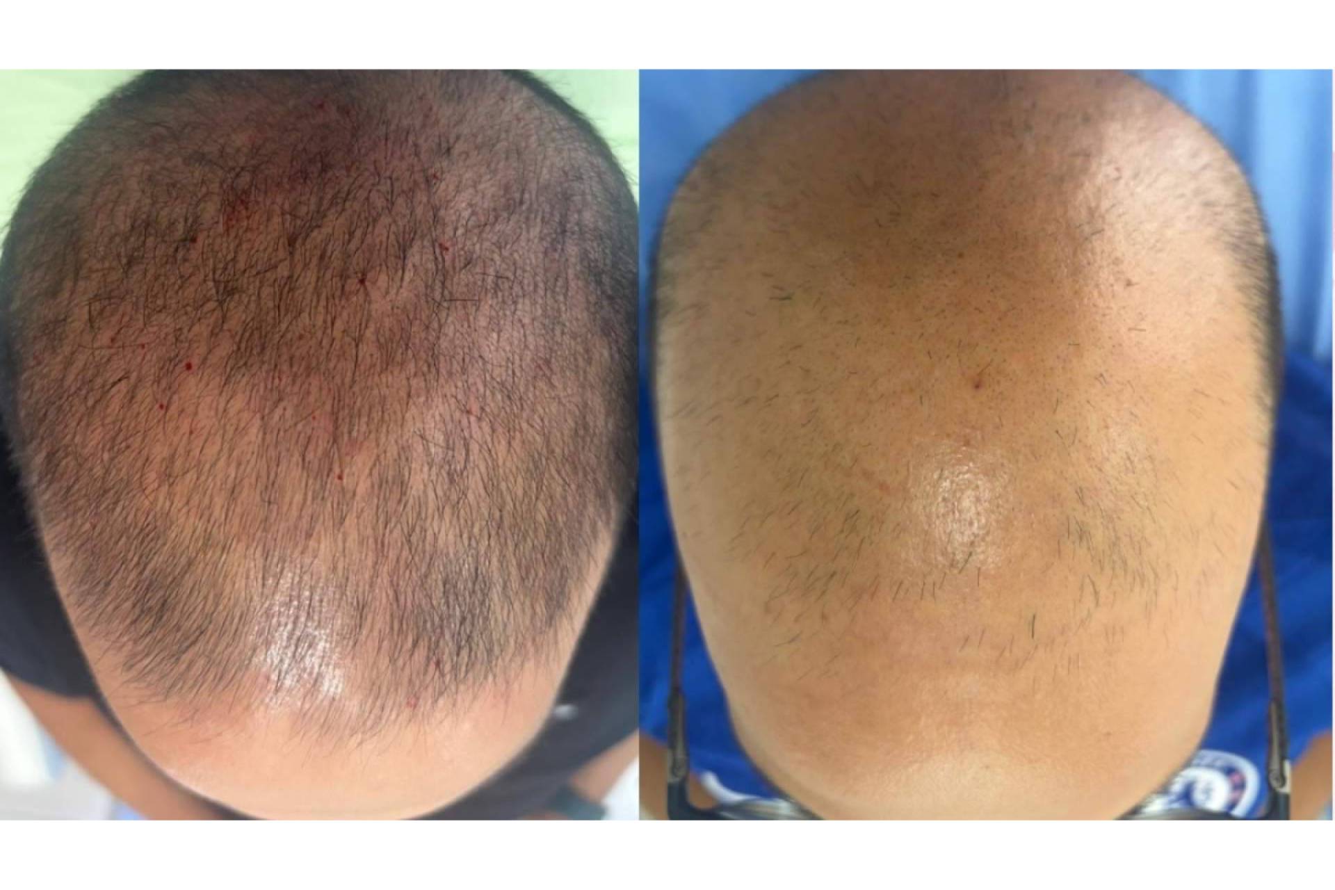 Alopecia androgenética, las novedades que marcarán el abordaje de la caída de cabello en 2027