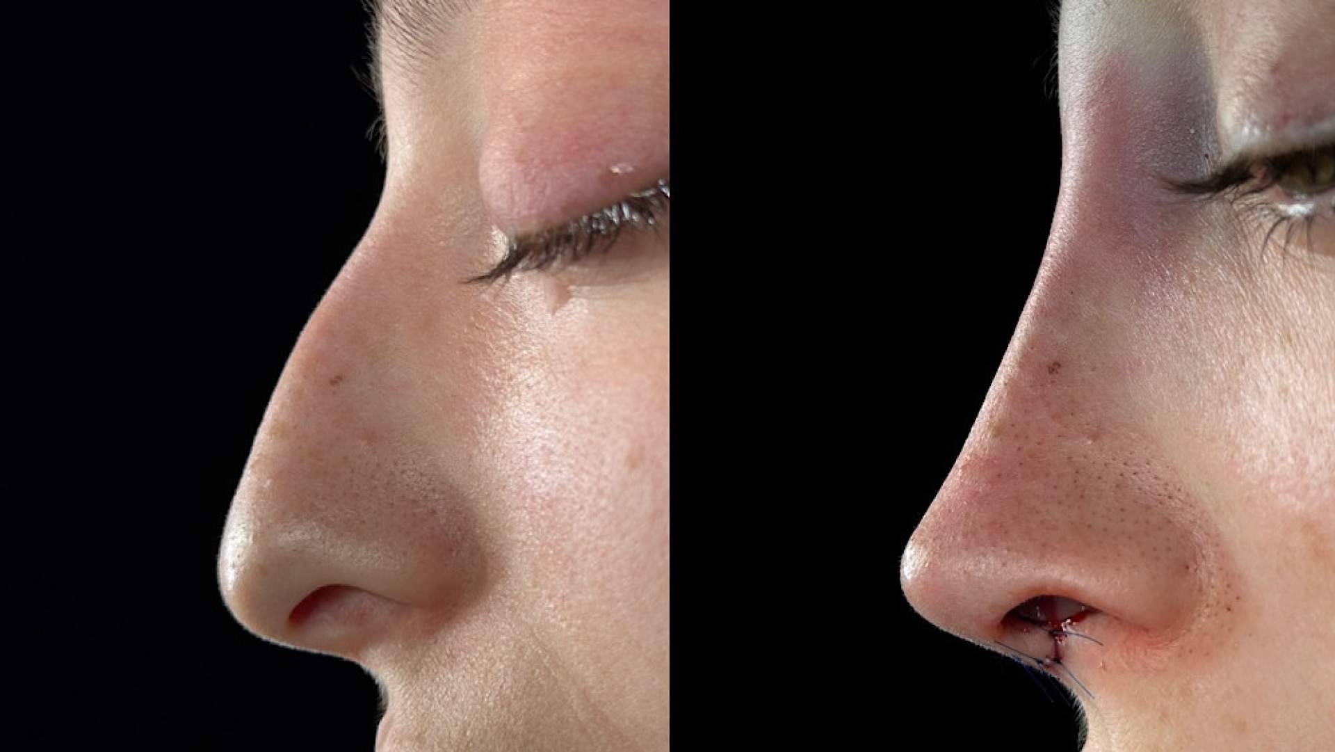 Rinoplastia personalizada, el método del Dr. Alfonso Campos para armonizar estética e identidad facial